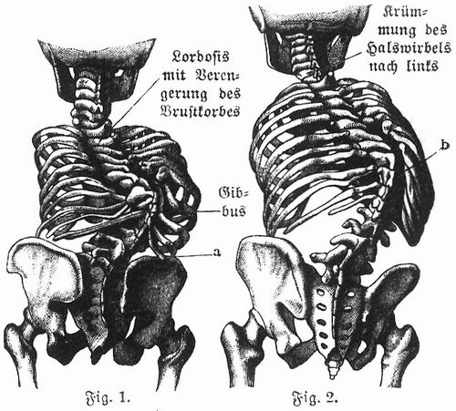 Fig. 1. Kyphosis der Wirbelsule im Brust- und Lendenteil. a Durch Verkrzung der Wirbelsule ...